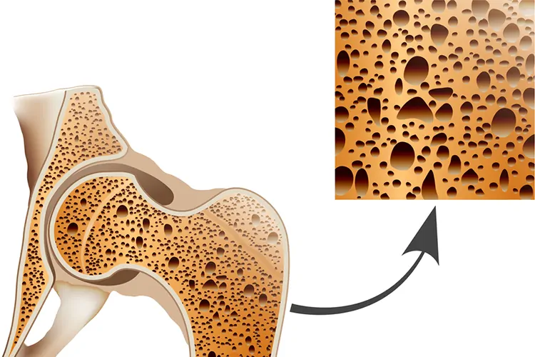 骨に穴があいてスカスカの状態になる骨粗鬆症｜仙台の木町通クリニック
